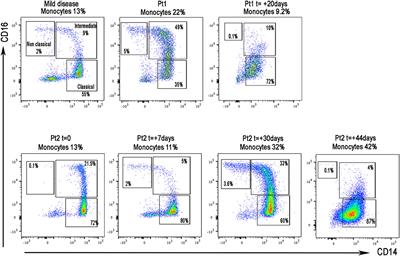 Hyperinflammation in Two Severe Acute Respiratory Syndrome Coronavirus 2-Infected Adolescents Successfully Treated With the Interleukin-1 Inhibitor Anakinra and Glucocorticoids